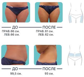 Криополиз - похудение без диет: уберём жировые кле