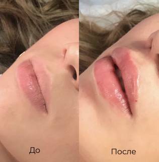 Уникальные методы увеличения губ и чистка лица